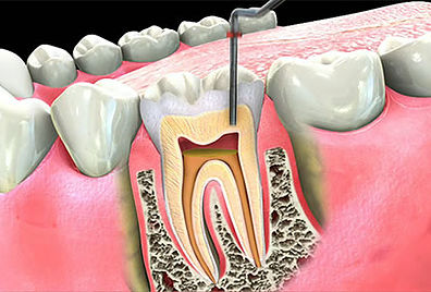 Root Canals Example