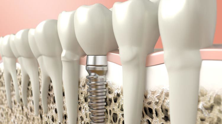 Dental Implant 3D Rendering