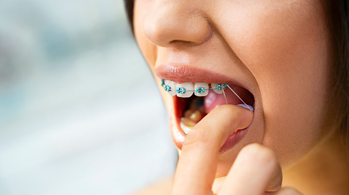 elastic band tik tok teeth straighten