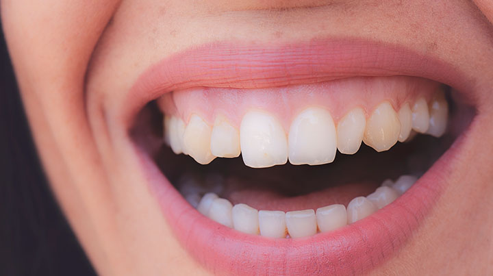 smiling girl with gums showing